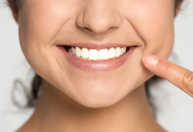 Teeth whitening