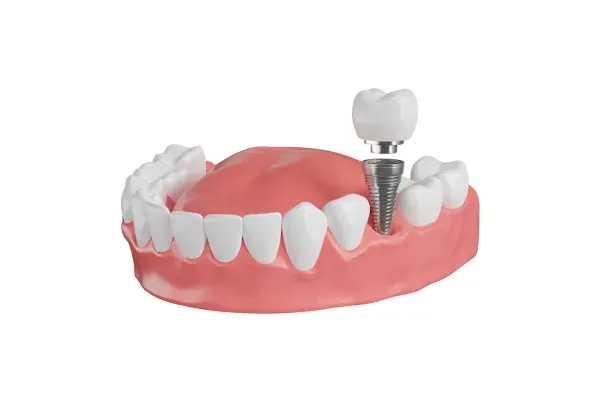 Dental Implant