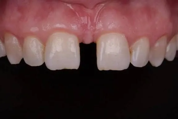 Midline Diastema Correction