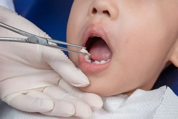 Deciduous tooth extraction