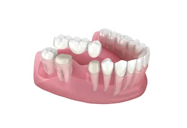 Premium Sofu Crown